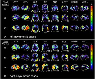 Detection Gap of Right-Asymmetric Neuronal Degeneration by CERAD Test Battery in Alzheimer’s Disease